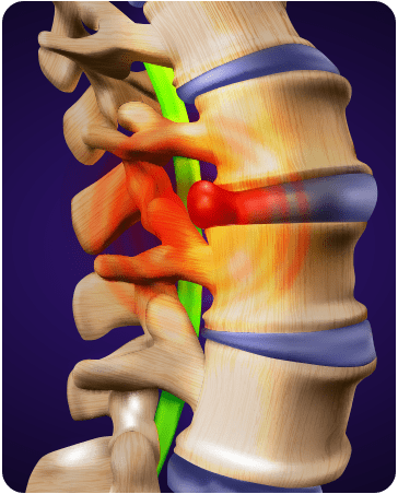 Back Pain