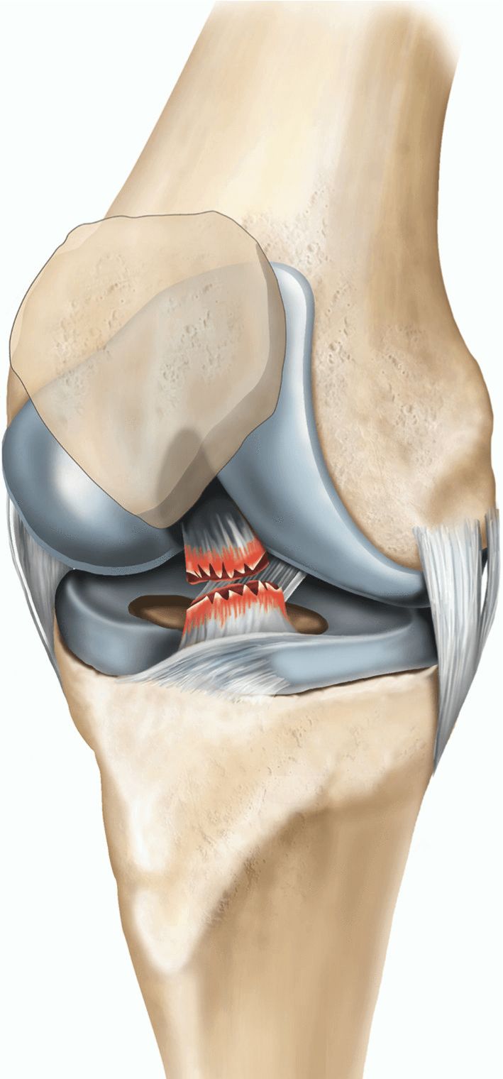 ACL surgery and MENISCUS REPAIR